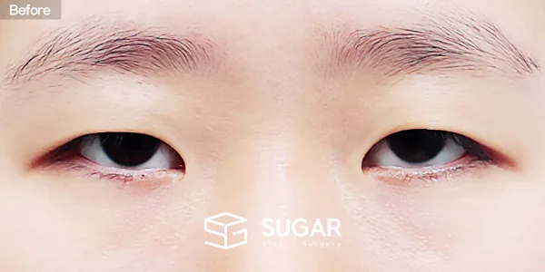 슈가성형외과 첫) 자연유착 + 눈매교정 + 앞트임 + 뒤밑트임 전후사진 - 수술 전