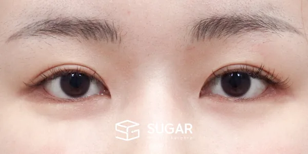 슈가성형외과 첫) 자연유착 + 눈매교정 + 윗트임 전후사진 - 수술 후