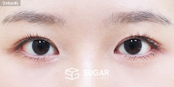 슈가성형외과 첫) 자연유착 + 눈매교정 + 앞트임 전후사진 - 수술 후