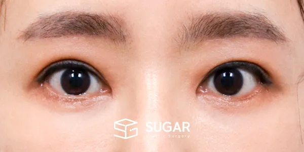 슈가성형외과 첫) 중안면부 거상 + 하안검 + 뒤밑트임 전후사진 - 수술 후