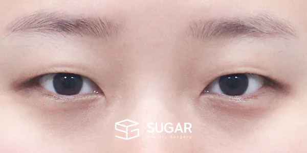 슈가성형외과 첫) 자연유착 + 눈매교정 + 뒤밑트임 전후사진 - 수술 전