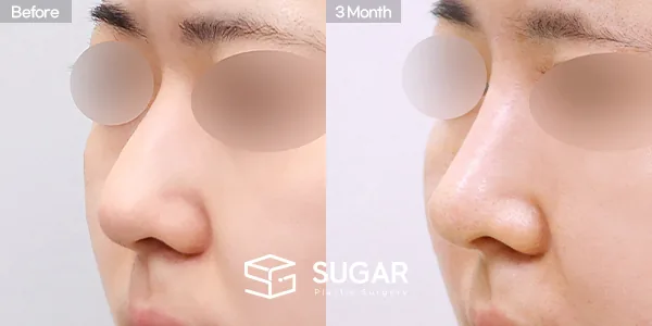 슈가성형외과 첫) 콧대 + 코끝 + 비중격연골 + 귀연골 + 매부리 + 절골 + 휜코 + 복코 + 비공내리기 전후사진 - 45도 수술 전후 비교