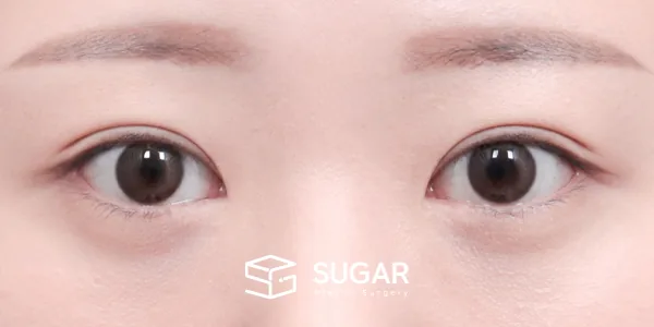 슈가성형외과 재) 절개 + 재수술 전후사진 - 수술 후