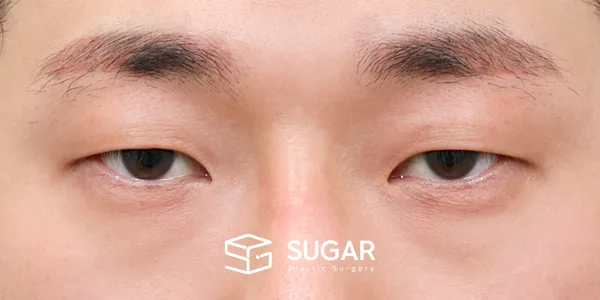 슈가성형외과 첫) 자연유착 + 눈매교정 전후사진 - 수술 전
