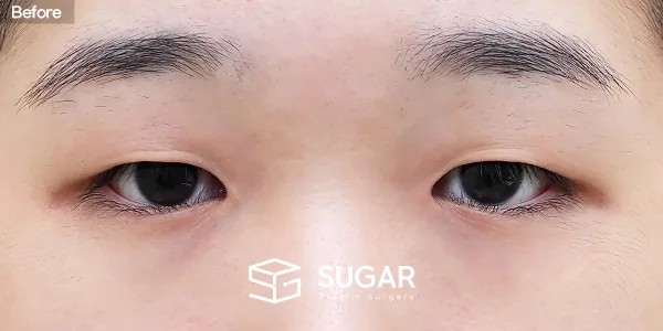 슈가성형외과 첫) 자연유착 + 눈매교정 + 앞트임 + 뒤밑트임 전후사진 - 수술 전