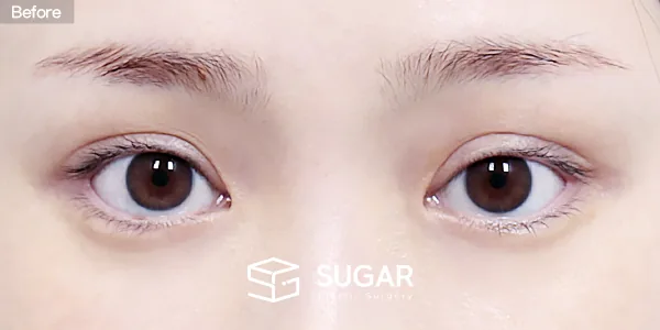 슈가성형외과 재) 재수술 + 절개 + 눈매교정 + 눈 두덩이 지방이식 전후사진 - 수술 전