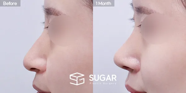 슈가성형외과 첫) 코끝+매부리코+휜코+복코+절골+비중격 전후사진 - 측면 수술 전후 비교