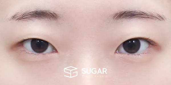 슈가성형외과 첫) 자연유착 + 눈매교정 + 윗트임 전후사진 - 수술 전