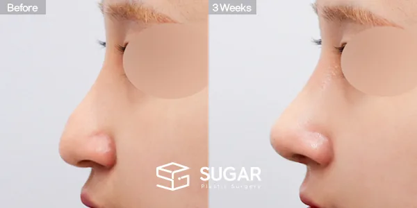 슈가성형외과 재) 재수술 + 복코 + 비중격 + 귀연골 전후사진 - 측면 수술 전후 비교
