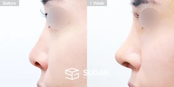 슈가성형외과 첫) 콧대 + 코끝 + 비중격연골 + 귀연골 + 복코 + 비공내리기 전후사진 - 측면 수술 전후 비교