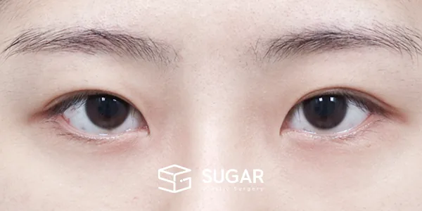 슈가성형외과 첫) 절개 + 윗트임 + 뒤밑트임 전후사진 - 수술 전