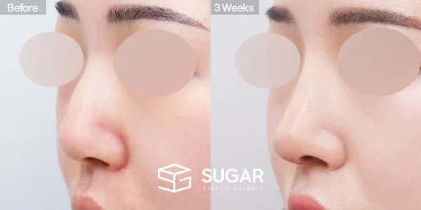 슈가성형외과 첫) 코끝 + 매부리코 + 무보형물 코성형 + 휜코 + 복코 + 절골 + 귀 뒤 근막 + 귀연골 전후사진 - 45도 수술 전후 비교
