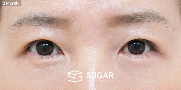 슈가성형외과 첫) 눈썹하거상술 + 하안검 전후사진 - 수술 후
