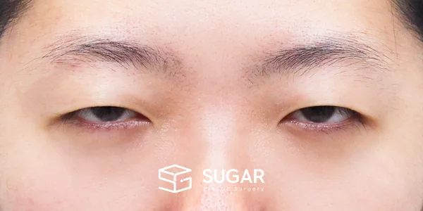 슈가성형외과 첫) 자연유착 + 눈매교정 + 윗트임 전후사진 - 수술 전