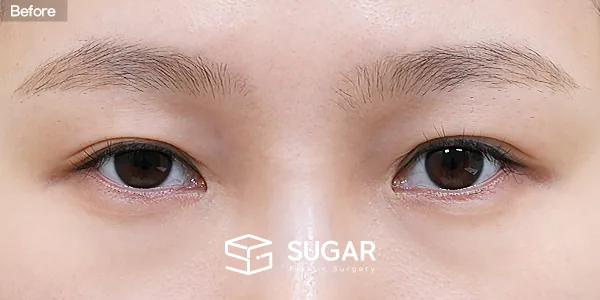 슈가성형외과 재) 재수술 + 자연유착 + 눈매교정 + 뒤밑트임 전후사진 - 수술 전
