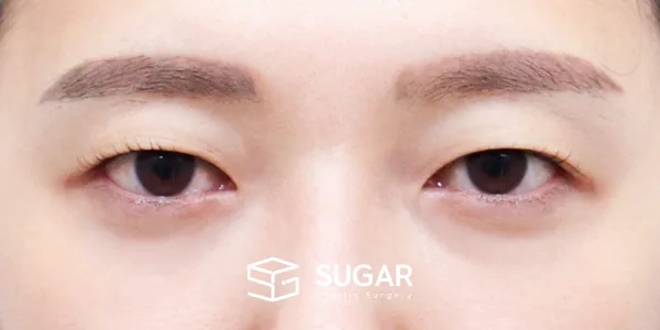 슈가성형외과 첫) 자연유착 + 눈매교정 전후사진 - 수술 전