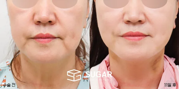 슈가성형외과 첫) 안면거상 + 심부볼 지방흡입 전후사진 - 전후 비교 사진
