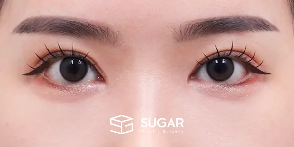슈가성형외과 첫) 밑트임[R] + 눈 밑 지방재배치 전후사진 - 수술 후