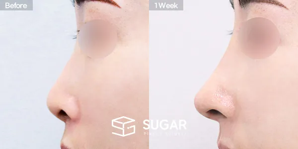 슈가성형외과 첫) 콧대 + 코끝 + 자가늑 + 휜코 + 절골 + 비공내리기 + 비순각교정 전후사진 - 측면 수술 전후 비교