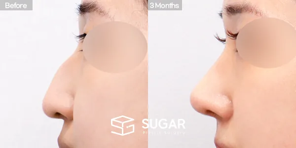 슈가성형외과 첫) 코끝 + 매부리코 + 비중격 + 귀연골 전후사진 - 측면 수술 전후 비교