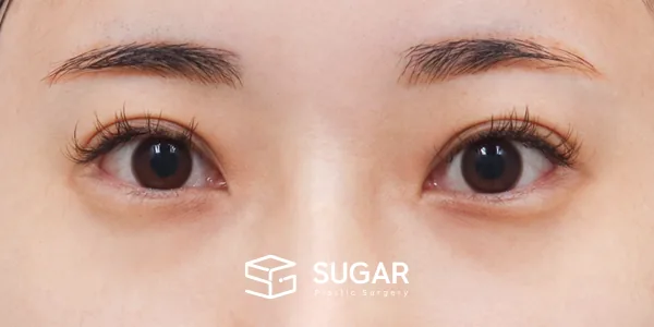 슈가성형외과 재) 재수술 + 2Point 웨이브 뒤밑트임 전후사진 - 수술 전