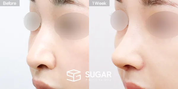 슈가성형외과 재) 재수술 + 무보형물 + 기증늑 + 매부리 + 절골 + 비순각교정 + 귀 뒤 근막 + 콧볼축소 전후사진 - 45도 수술 전후 비교