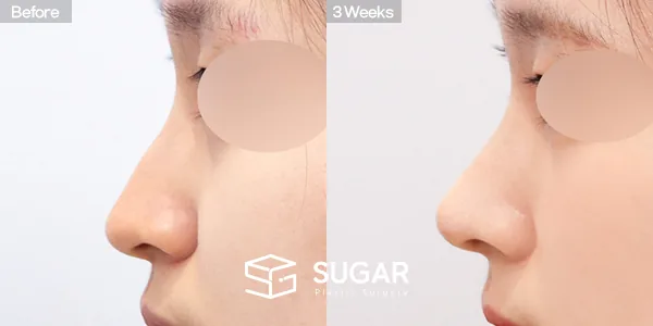 슈가성형외과 첫) 코끝 + 매부리코 + 복코 + 휜코 + 귀연골 전후사진 - 측면 수술 전후 비교