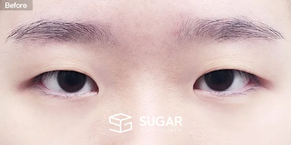 슈가성형외과 첫) 자연유착 + 눈매교정 + 앞트임 전후사진 - 수술 전