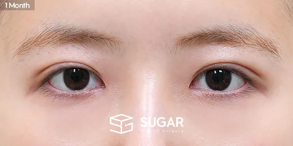 슈가성형외과 첫) 자연유착 + 앞트임 + 윗트임 전후사진 - 수술 후