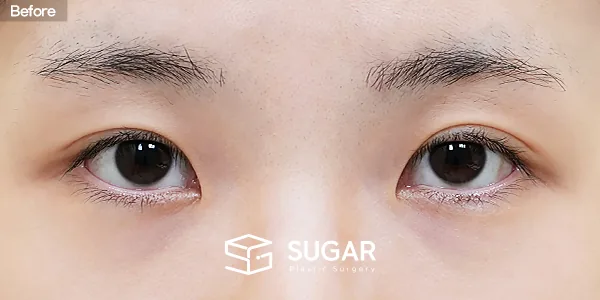 슈가성형외과 첫) 자연유착 + 눈매교정 + 앞트임 + 윗트임 + 뒤밑트임 전후사진 - 수술 전