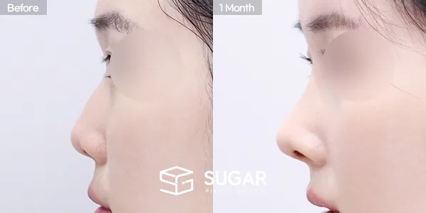 슈가성형외과 첫) 콧대+코끝+매부리코+짧은코+비중격연장+비주연장+자가늑 전후사진 - 측면 수술 전후 비교