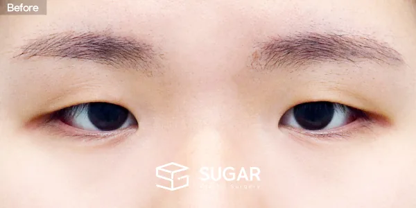 슈가성형외과 첫) 자연유착 + 눈매교정 + 앞트임 전후사진 - 수술 전