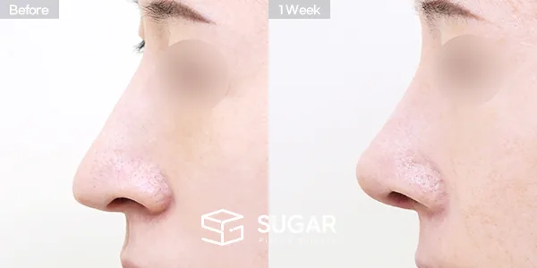 슈가성형외과 재) 재수술 + 무보형물 + 긴코 + 휜코 + 매부리 + 절골 + 기증늑 + 귀연골 + 귀 뒤 근막 + 비중격만곡증 전후사진 - 측면 수술 전후 비교
