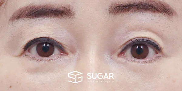 슈가성형외과 첫) 눈썹 거상 + 자연유착 전후사진 - 수술 전