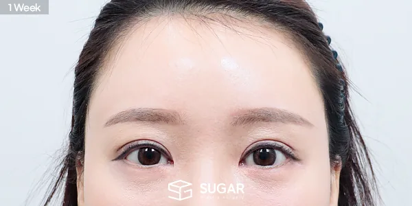 슈가성형외과 재) 자연유착 재수술 + 이마거상 전후사진 - 수술 후