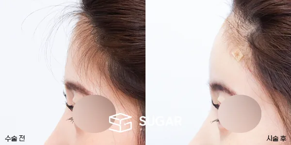 슈가성형외과 첫) 이마필러 전후사진 - 전후 비교 사진