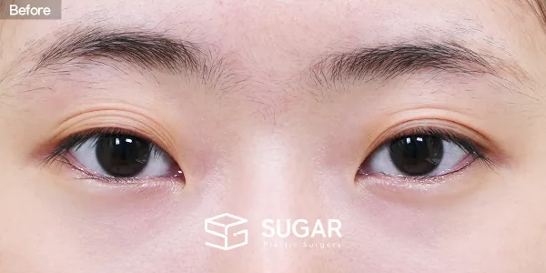 슈가성형외과 첫) 자연유착 + 눈매교정 전후사진 - 수술 전