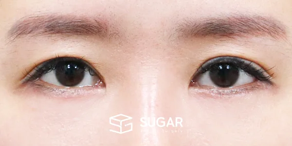 슈가성형외과 첫) 하안검 + 중안면부 거상 전후사진 - 수술 후