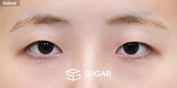 슈가성형외과 첫) 자연유착 + 앞트임 + 윗트임 전후사진 - 수술 전