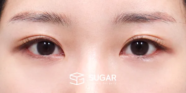 슈가성형외과 첫) 뒤밑트임 전후사진 - 수술 후