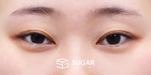 슈가성형외과 첫) 밑트임 전후사진 - 수술 전