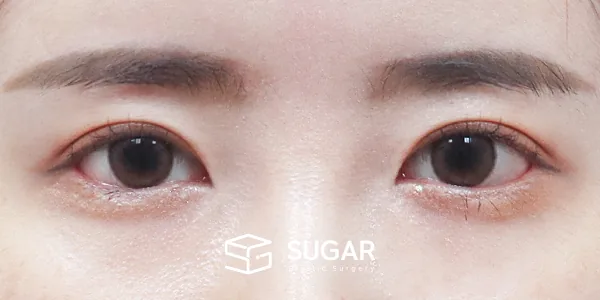 슈가성형외과 재) 재수술 + 절개 + 뒤밑트임 전후사진 - 수술 후