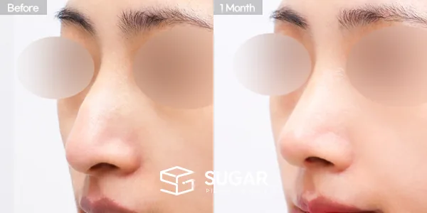 슈가성형외과 첫) 콧대 + 코끝 + 매부리코 + 무보형물 코성형 + 휜코 + 절골 + 비주교정 + 비중격 전후사진 - 45도 수술 전후 비교