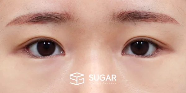 슈가성형외과 재) 재수술 + 뒤밑트임 전후사진 - 수술 후