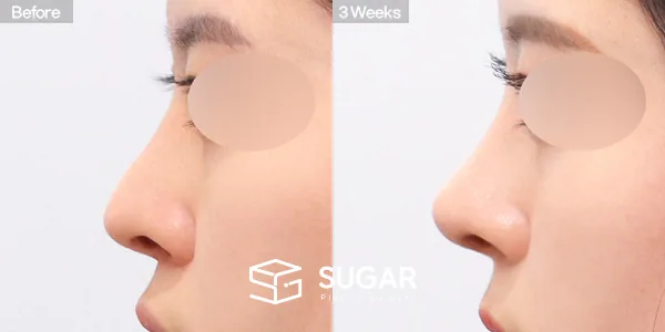 슈가성형외과 재) 재수술 + 매부리코 + 휜코 + 비공 내리기 + 비중격 전후사진 - 측면 수술 전후 비교