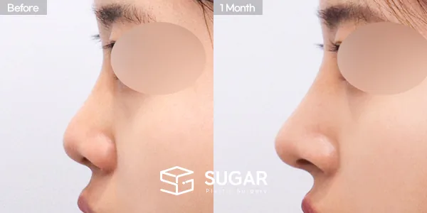 슈가성형외과 첫) 콧대 + 코끝 + 귀연골 전후사진 - 측면 수술 전후 비교