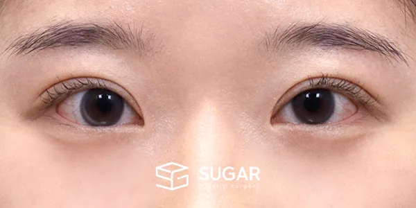 슈가성형외과 첫) 자연유착 + 윗트임 전후사진 - 수술 후