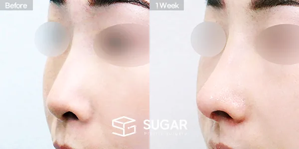 슈가성형외과 첫) 콧대 + 코끝 + 자가늑 + 휜코 + 절골 + 비공내리기 + 비순각교정 전후사진 - 45도 수술 전후 비교