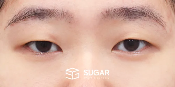 슈가성형외과 첫) 자연유착 + 눈매교정 + 윗트임 전후사진 - 수술 전