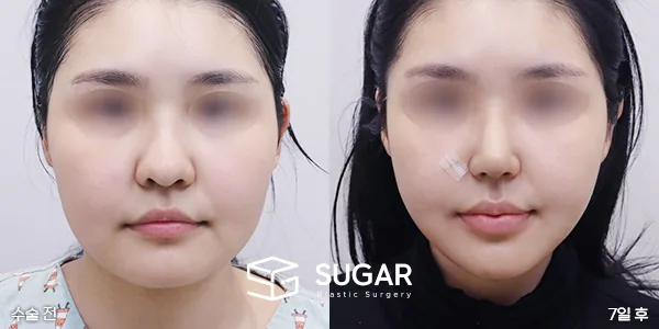 슈가성형외과 첫) 콧대+코끝+복코+비주지지+귀연골+얼굴지방흡입+민트실리프팅+입술필러+입꼬리보톡스+턱보톡스 전후사진 - 45도 수술 전후 비교